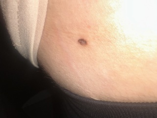 Moles or skin tag