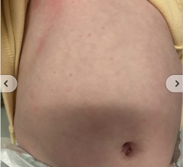 What could this be? Chicken pox?