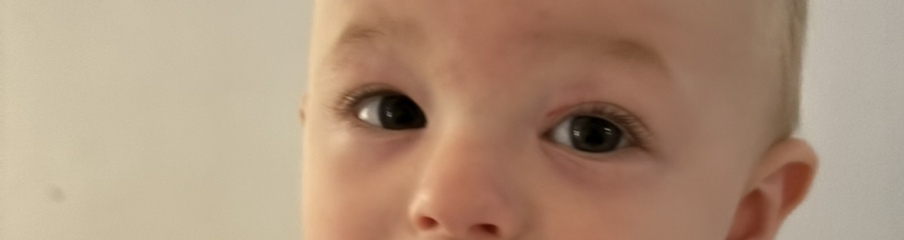 Random bruise under baby’s eye