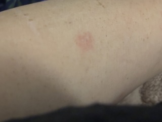 Ringworm?