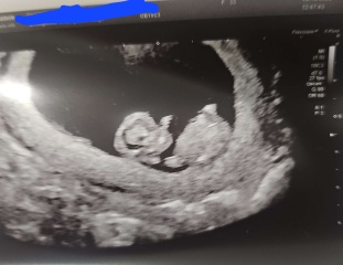 10 weeks 2 days scan - Skull/Ramzi theory