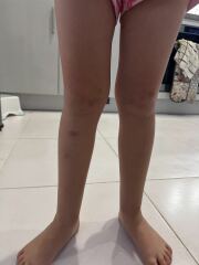 Is this a concerning amount of bruises?