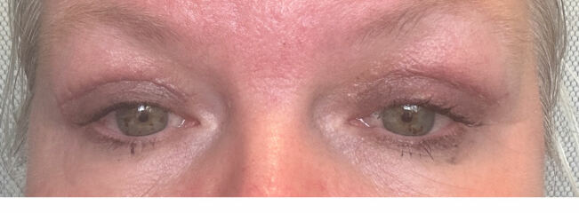 I’m thinking of blepharoplasty.