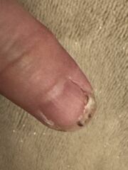 Ripped fingernail hell
