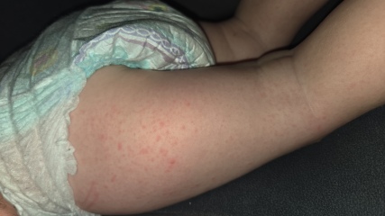 Does this look like the start of chickenpox?