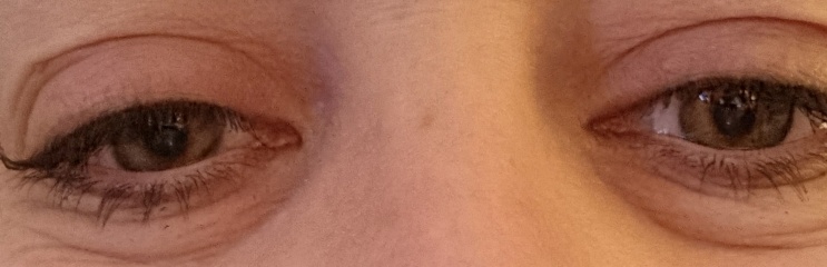 Dark puffy eyes