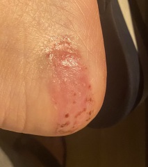 Can anyone help with my eczema? Horrible pics attached!