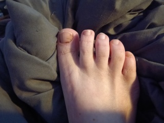 Worrisome toenails(both big toes)