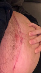 Painful c section scar