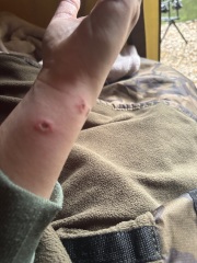 Tick bite?? Does any one have any idea what type of bites these are??