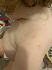Chickenpox?