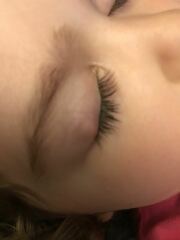 Chalazion removal?