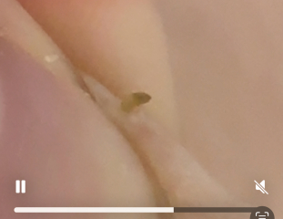 Satisfying blackhead squeeze!