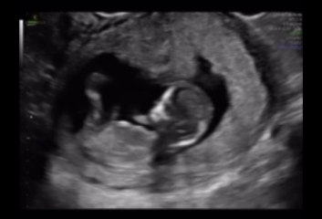 NUB theory/Sex Guess