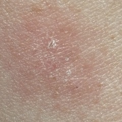 Ringworm?