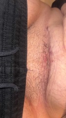 Painful c section scar