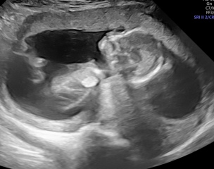 private 15 week scan- worried about spinal bifida