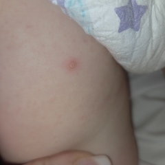 Does this look like the start of chickenpox?