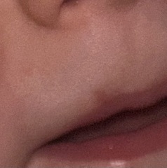 rash above babies lip