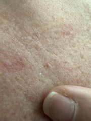Blister looking growth on chest. Advice please