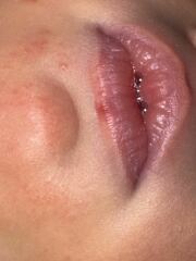 Bump on 7 day old daughters lip