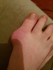 How the hell to cope with bunions?!