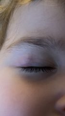 Chalazion removal?