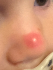 Lump on child’s nose