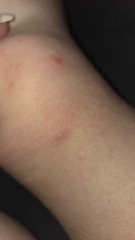 Does this look like the start of chickenpox?