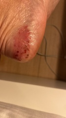 Can anyone help with my eczema? Horrible pics attached!