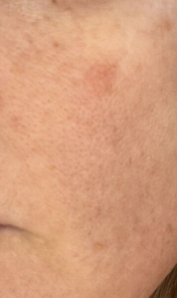 Has anyone had similar on their face. Is it skin cancer?