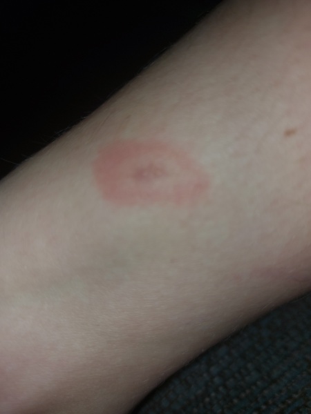 Spider bite or...