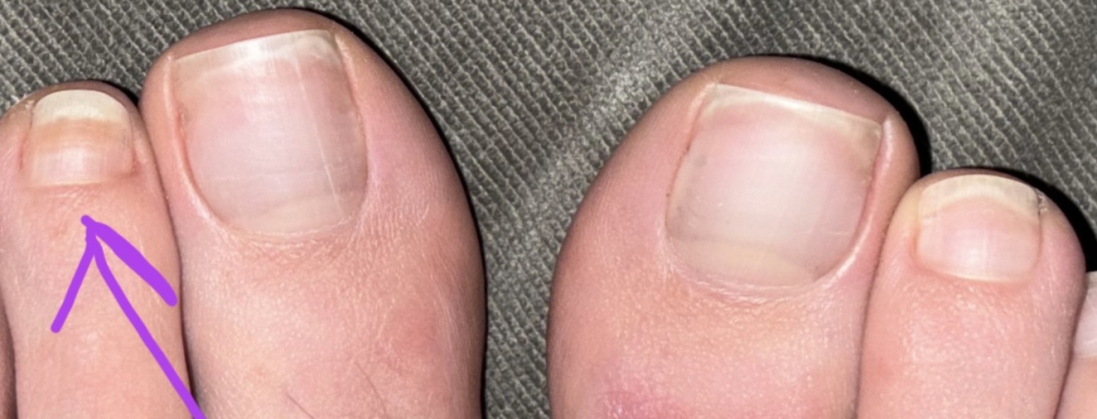 Toe nail fungus?