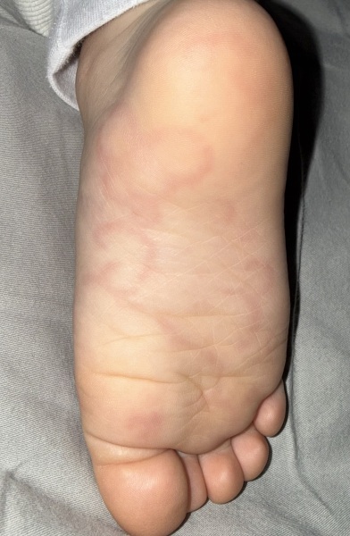 What does this rash look like??