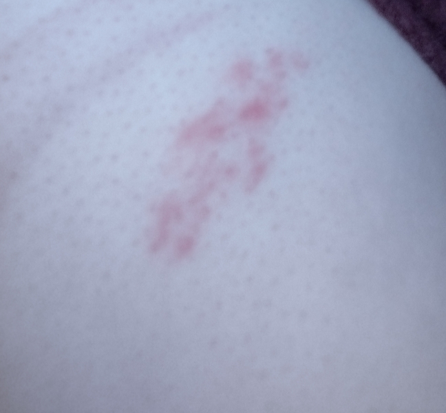 Does this look like shingles?