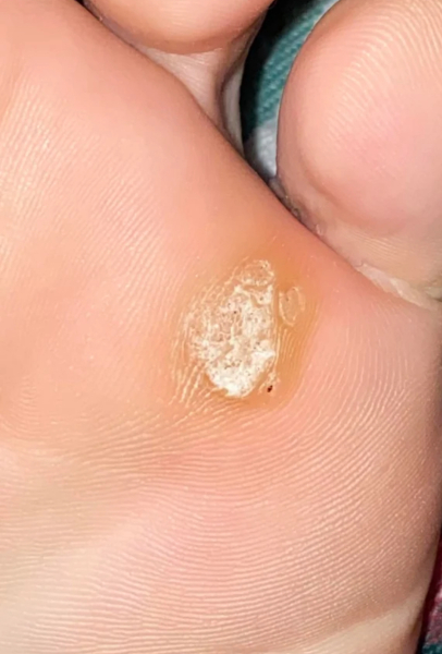 My impossible verruca