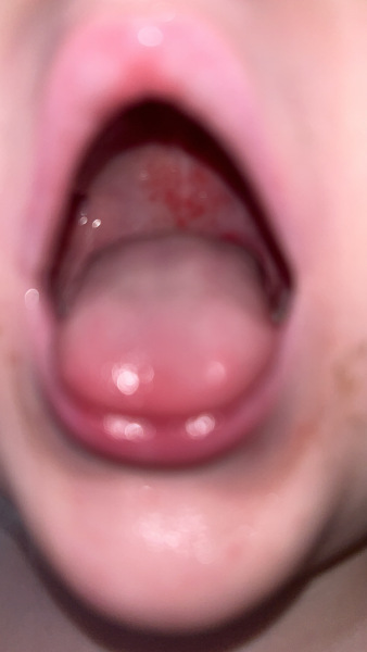 Is this Hand, Foot & Mouth?