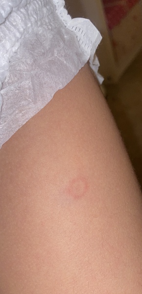Does this look like Ringworm?