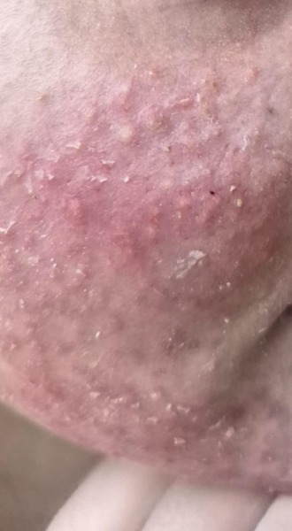 Any skin specialist here please? What is this on my child face?