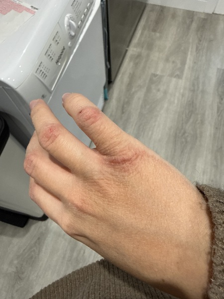 Dry cracked hands