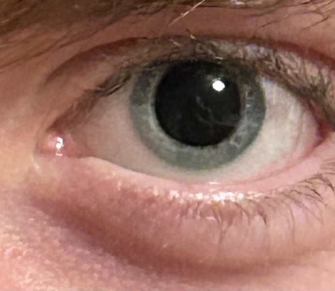 Freaking out a bit about dilated pupils