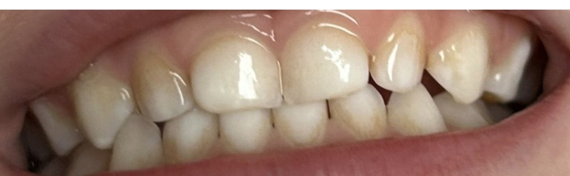 Does this look like tooth decay?