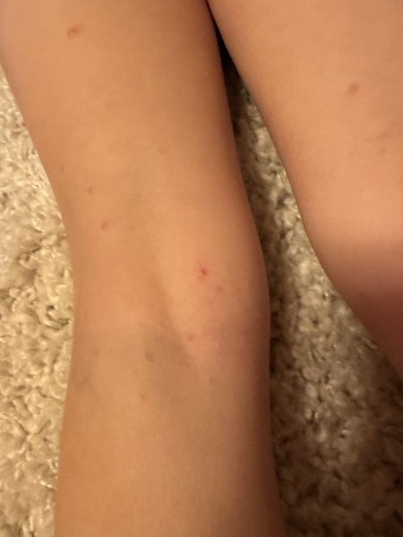 Is this chicken pox?!