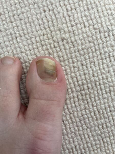 What has happened to my big toe?