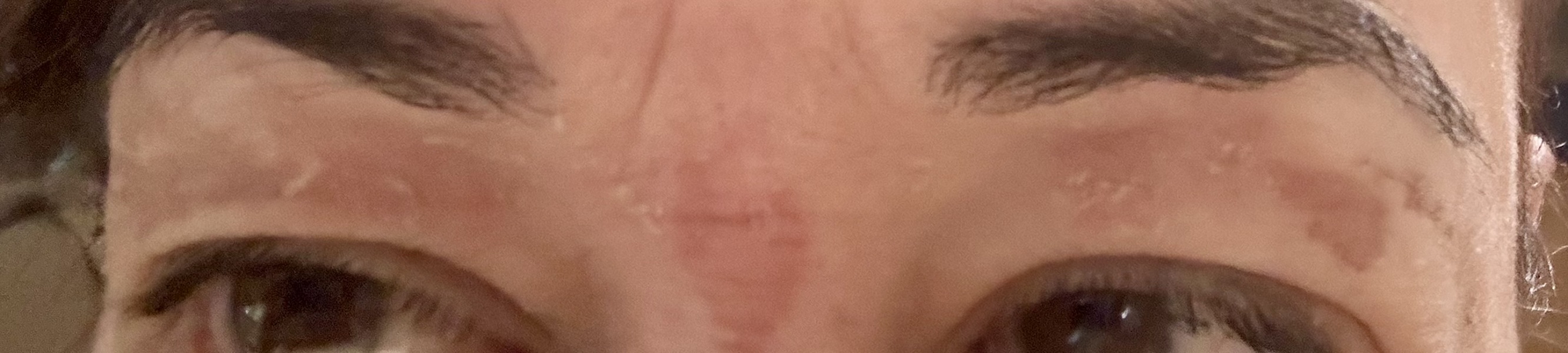To sue Superdrugs? Eyesbrow burns