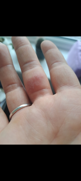 Does this look like shingles?