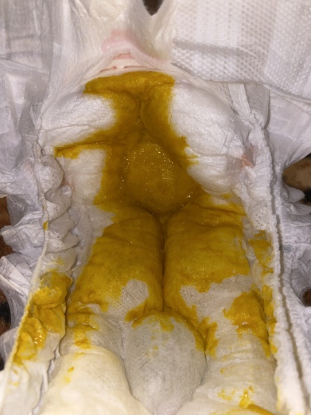 Is this poop normal? (TMI pictures)