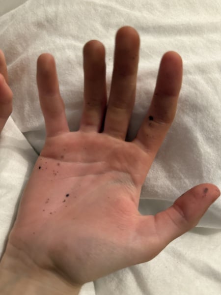 What are these black dots / marks on my daughter’s hands