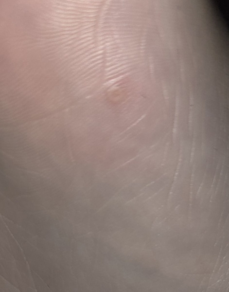 Anyone know what this is on my childs foot? Is it a verruca or a corn... pain when walking