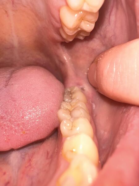 Horrible pic sorry teeth related
